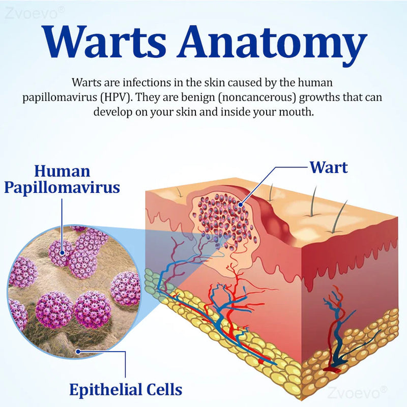 Creme BeeDerm RX | Cuidado suave e direcionado para verrugas, acrocórdons, caroços, infecções, cistos e cicatrizes