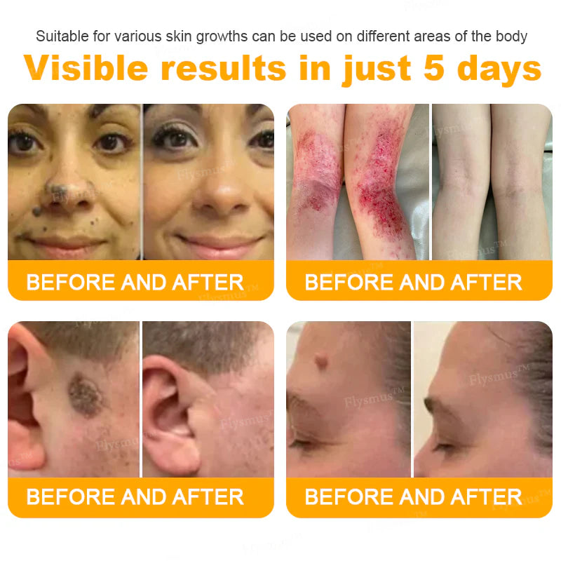 Bee Remove | Creme Reparador para Remoção de Verrugas com Veneno de Abelha