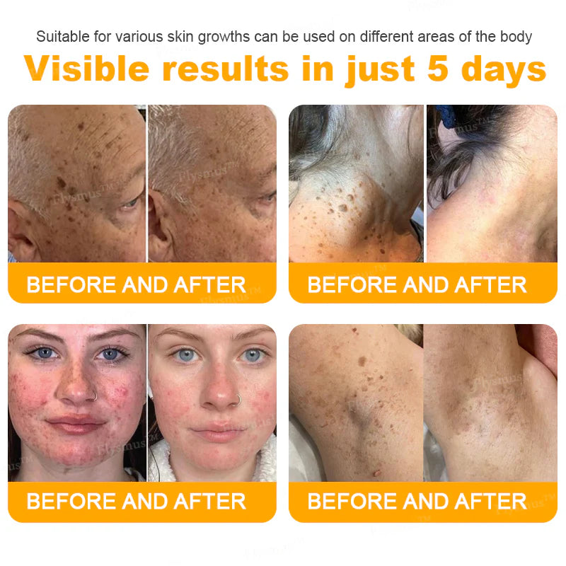 Bee Remove | Creme Reparador para Remoção de Verrugas com Veneno de Abelha