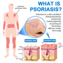 Spray Herbal (Remove verrugas, clareia manchas e alivia a psoríase enquanto transforma sua pele de forma rápida e segura)