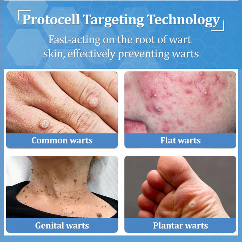 Creme BeeDerm RX | Cuidado suave e direcionado para verrugas, acrocórdons, caroços, infecções, cistos e cicatrizes