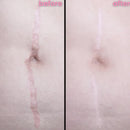 DermaSil | Fita Cicatrizante