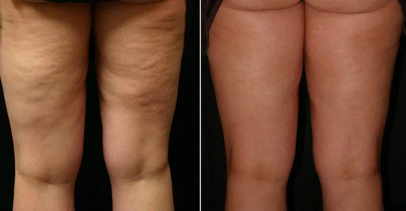 Bastão Botox Bee | Rejuvenescedor