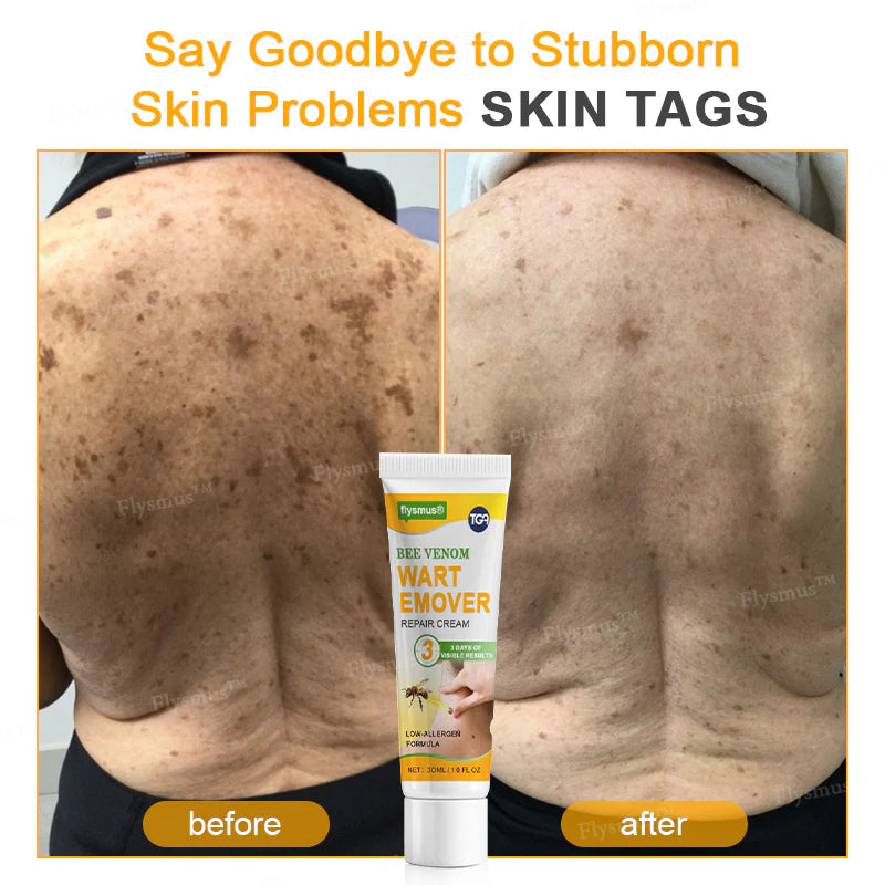 Bee Remove | Creme Reparador para Remoção de Verrugas com Veneno de Abelha