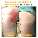 Bee Remove | Creme Reparador para Remoção de Verrugas com Veneno de Abelha