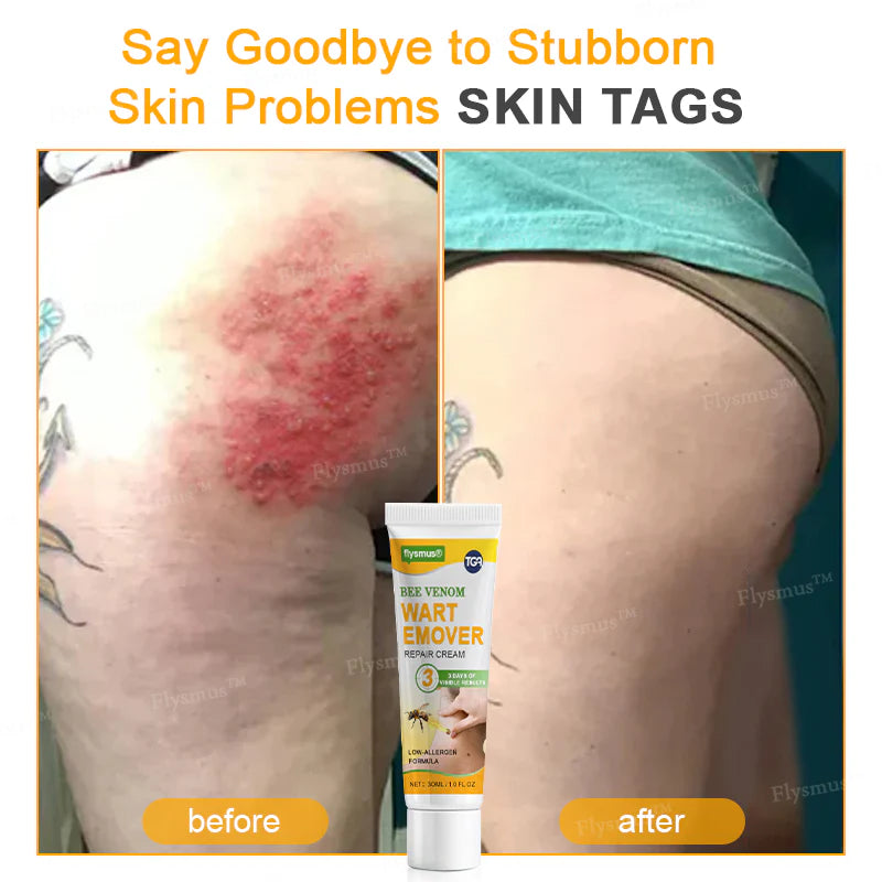 Bee Remove | Creme Reparador para Remoção de Verrugas com Veneno de Abelha