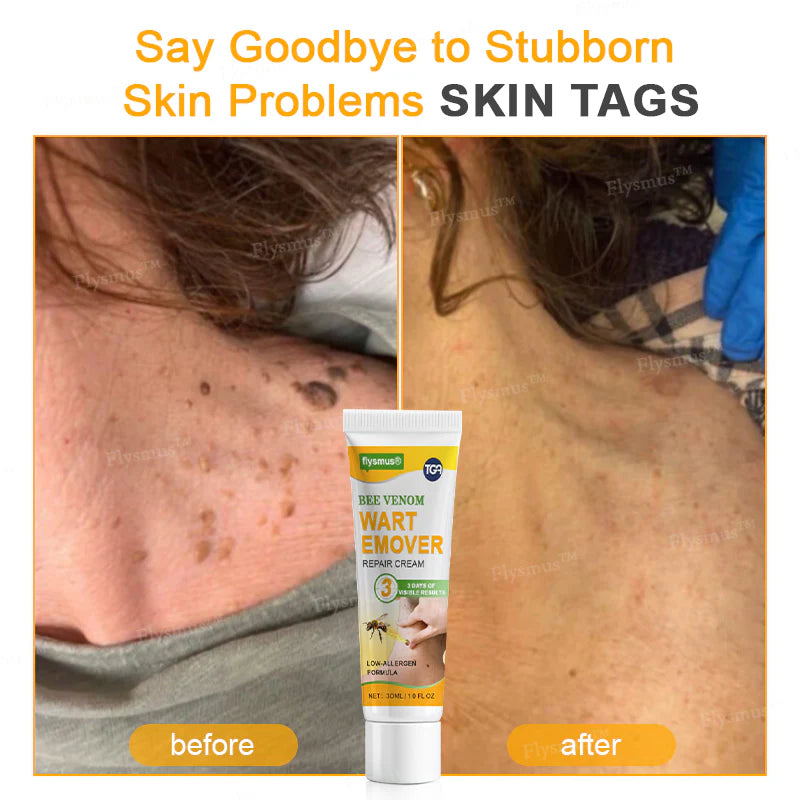 Bee Remove | Creme Reparador para Remoção de Verrugas com Veneno de Abelha