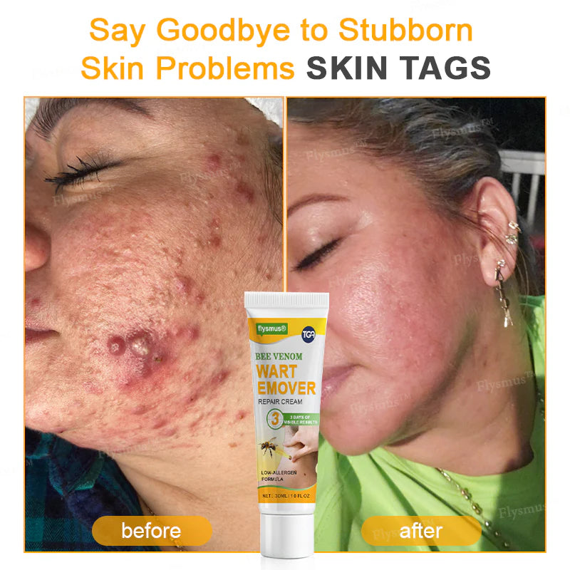 Bee Remove | Creme Reparador para Remoção de Verrugas com Veneno de Abelha